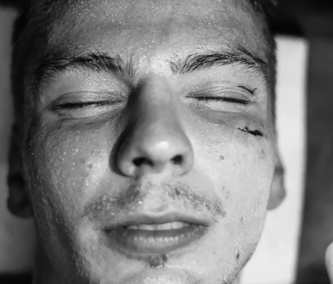 stitches from muay thai boxing